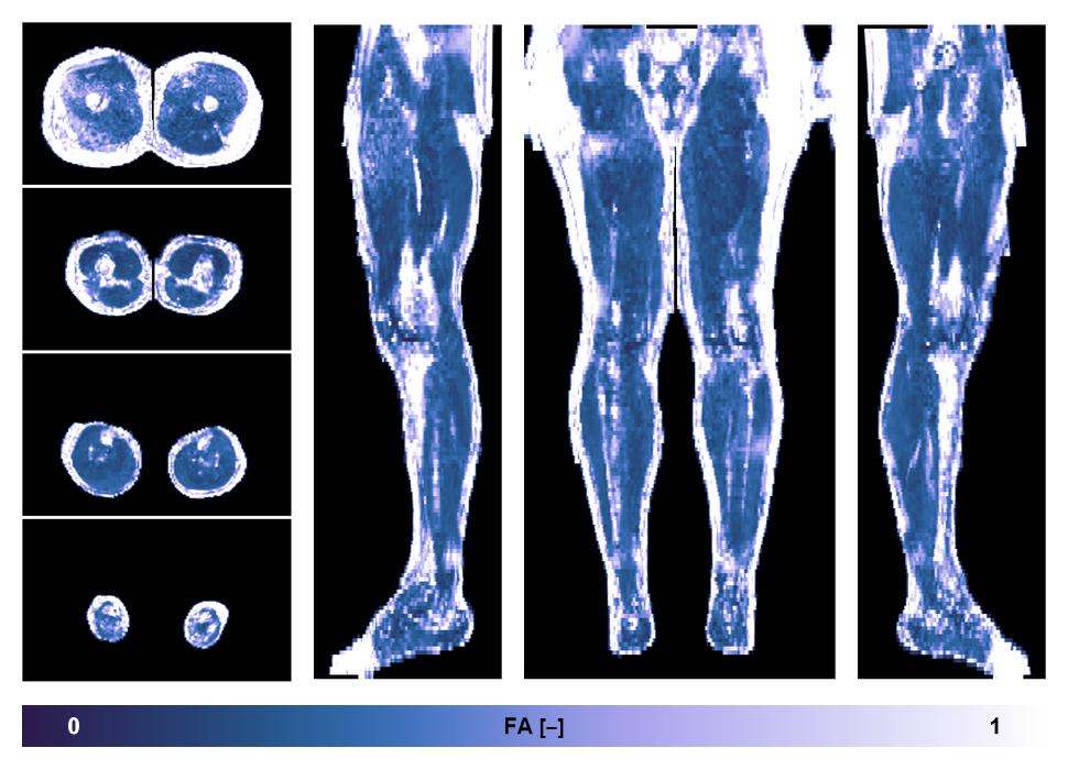 IVIM corrected whole leg muscle fractional anisotropy obtained from diffusion tensor imaging.